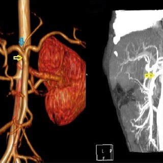 Abdominal computed tomography angiography shows that the celiac trunk... | Download Scientific ...