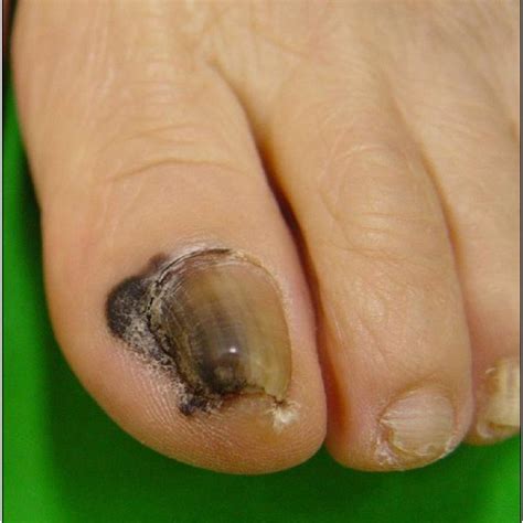 Hutchinson's nail sign. Black pigmented patch spreading onto the skin... | Download Scientific ...