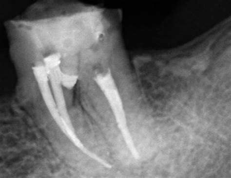 Angelus MTA Repair HP Bioceramic Cement – Clinical Research Dental