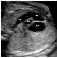 fetal heart rvot ultrasound - Bing Images | Ultrasound stuff | Pinterest