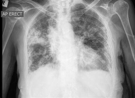 Pulmonary Consolidation | Chest X-Ray - MedSchool