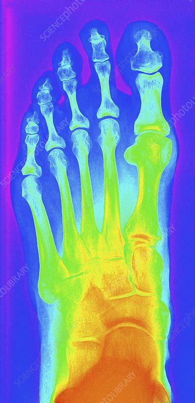 Normal Left Ankle Xray