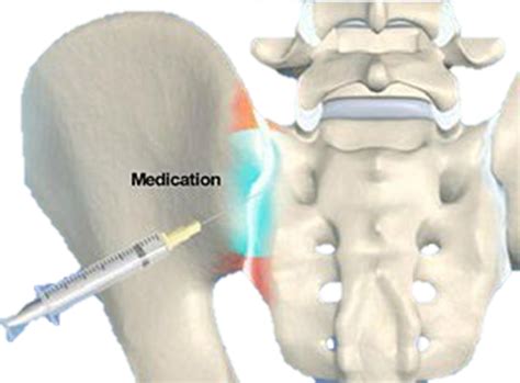 Sacroiliac Joint Pain - Rehab On The Road