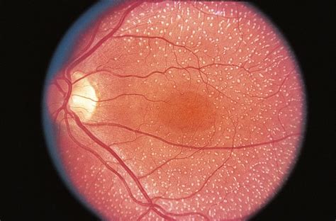 Fundus albipunctatus - American Academy of Ophthalmology