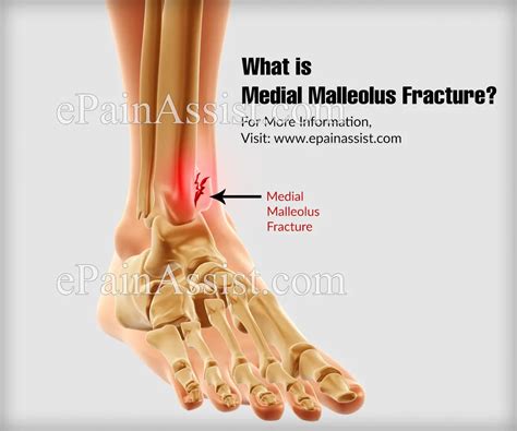 Medial Malleolus Fracture|Causes|Symptoms|Treatment|Recovery Time|Diagnosis