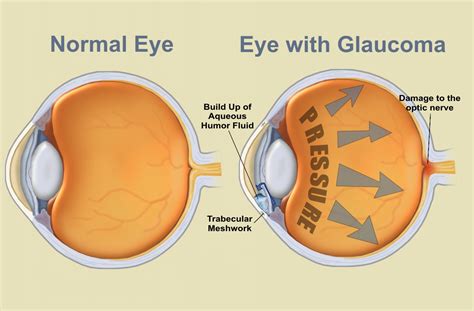 Eye Disease Glaucoma- Symptoms, Management, Treatment and Prevention