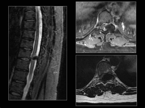 foraminal stenosis | pacs