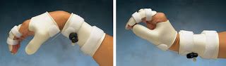 OCCUPATIONAL THERAPY ; SPLINTING: Variety of Splint