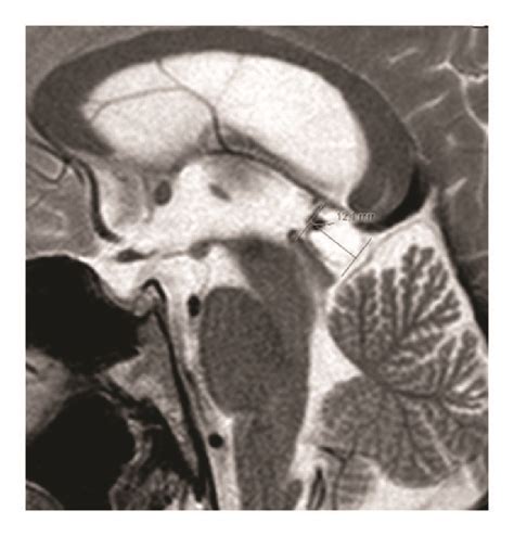 MRI of sella turcica at admission (August 2014): heterogeneous... | Download Scientific Diagram