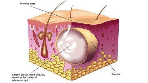 Sebaceous Cyst Removal - Excision Gold Coast | Skin Clinic Robina