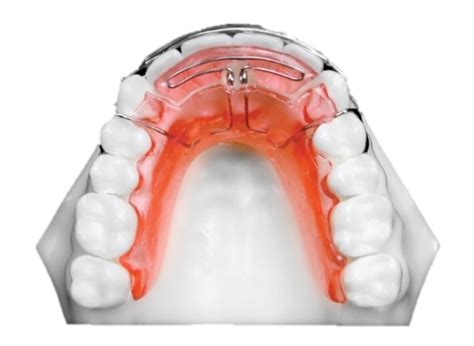 Spring Hawley Retainer Upper – Lower – BM Ortho Appliances Inc.