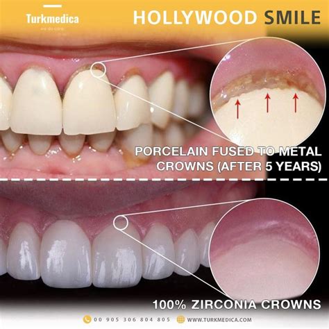 What is better porcelain or zirconia? Zirconia has a few additional ...