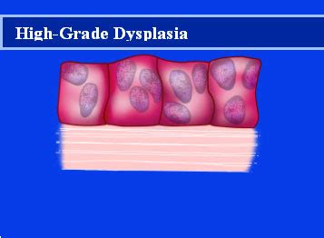 Barrett’s Esophagus - Causes, Symptoms, Diagnosis , and Treatment | All About Acid Reflux | GERD ...