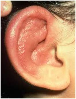 Outer Ear & Diseases Related To It - Denoc