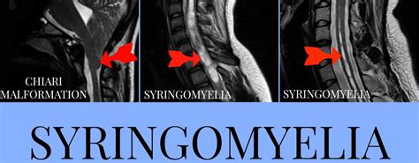 Syringomyelia - Causes, Symptoms, Prognosis, Treatment