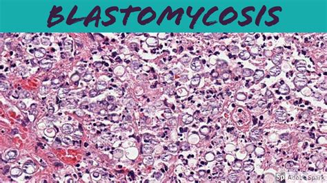 Blastomycosis Histology