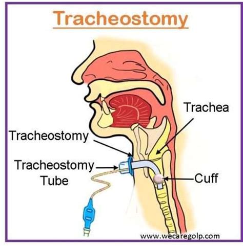 Tracheostomy: Purposes, Indications, Risks - We Care