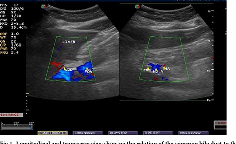 Figure 1 from Sonographic measurement of normal common bile duct diameter and associated factors ...