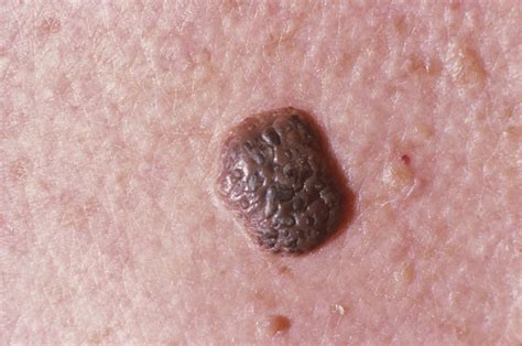 Seborrheic Keratoses: Everything You Need to Know