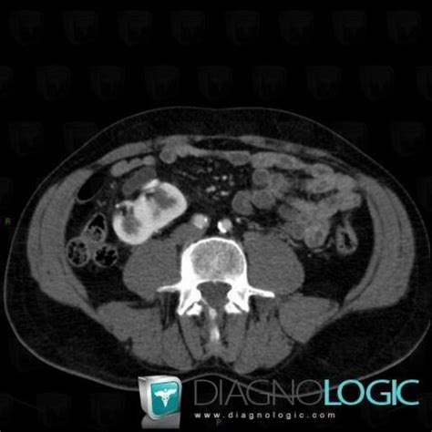 Radiology case : Renal malrotation (CT) - Diagnologic