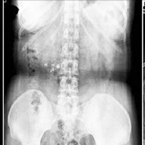 B. Preoperative axial CT, KUB, and postoperative KUB images of a ...