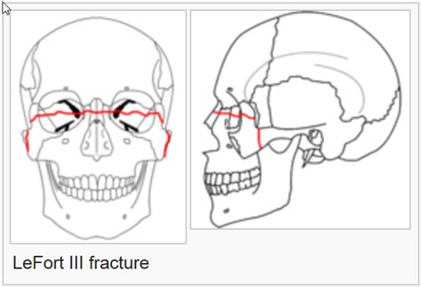 Maxillary Fracture Classification