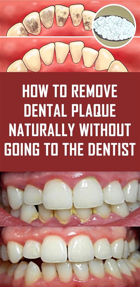 Famous How To Get Rid Of Plaque On Teeth Without Going To The Dentist ...