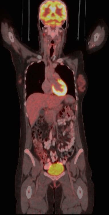 Omental mass at greater omentum. | Download Scientific Diagram