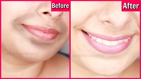 Remove Dark, Black Patches Around Mouth in 15 Minutes || Get Rid of Hyper-pigmentation - YouTube