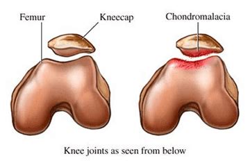 Chondromalacia Patella - Presentation and Treatment | Bone and Spine