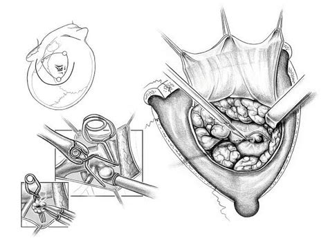 Frontotemporal craniotomy for posterior communicating artery aneurysm clipping Poster Print by ...