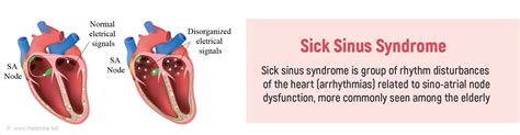 Sick Sinus Syndrome - Causes, Symptoms, Diagnosis, Treatment & Prevention