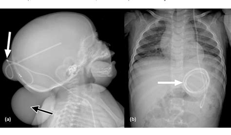 [PDF] Is shunt series X-ray necessary before revision of obstructed ...