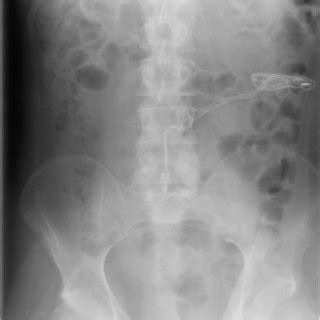 X-ray of abdomen, taken on 11 November 2009, showed faecal loading of... | Download Scientific ...