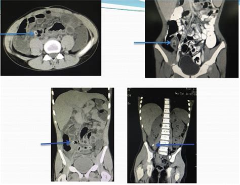 CT images show fecalith and acute appendicitis in equivocal cases ...