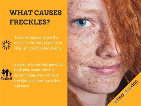 What Causes Freckles? | FindATopDoc