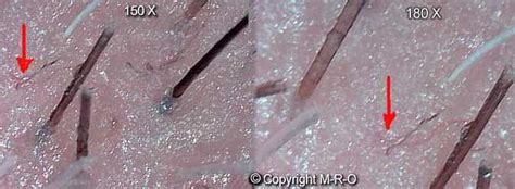 Morgellons Skin-Infection-Process by Fibers and Biofilm