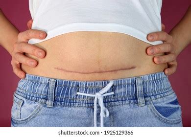 106 Hysterectomy scar Images, Stock Photos & Vectors | Shutterstock