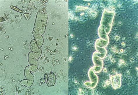 Urine Sediment of the Month: Pigmented Casts & What Those Pretty Colors Tell Us - Renal Fellow ...