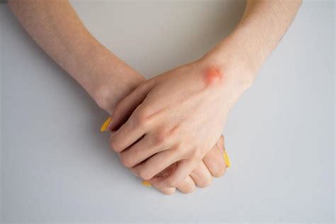 Ganglion Cysts- Causes and Treatments : Elite Sports Medicine + Orthopedics: Orthopedics