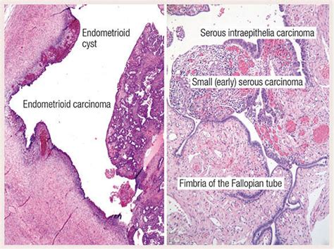 Serous Ovarian Cancer Histology - CancerWalls