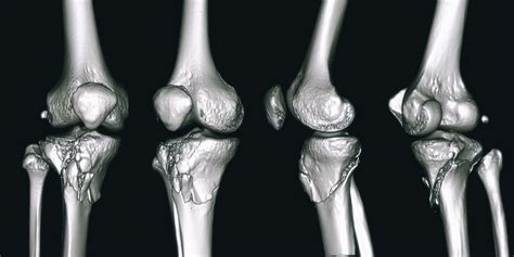 Tibial Plateau Fractures | Knee Surgeon | Minnesota