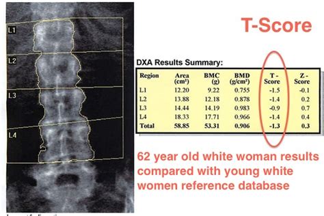 T-score - 4BoneHealth