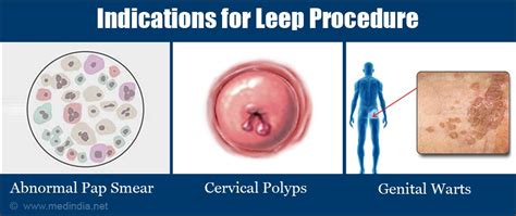 LEEP (Loop Electrosurgical Excision Procedure) - Indications, Preparation, Procedure, Recovery ...