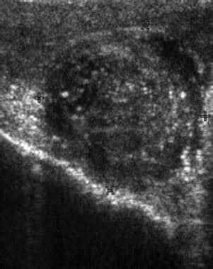 Epididymitis Imaging: Practice Essentials, Ultrasonography, Magnetic resonance imaging (MRI)