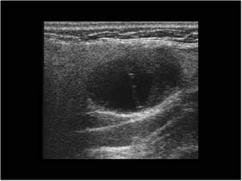 Head and Neck | 4.3 Salivary glands : Case 4.3.4 Warthin's tumors | Ultrasound Cases