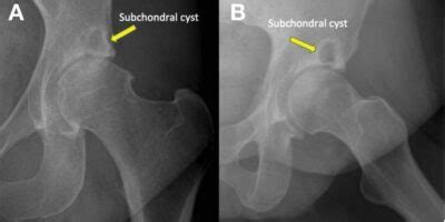 Hip Cysts | Acetabular Paralabral Cyst & Subchondral Cyst | FAI | Manhattan, New York City, NY