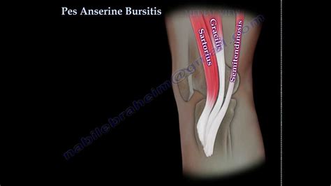 Knee Bursitis - Carolina Regional Orthopedics