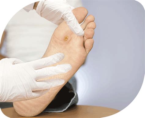 Diabetic Foot Ulcer Treatment & Surgery Cost In Trivandrum