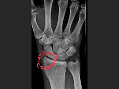 Styloid Process Of Radius Pain